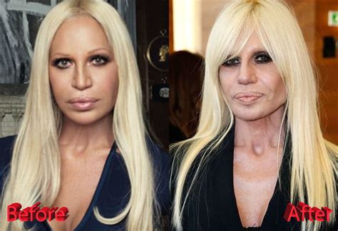 vestido donatella versace|donatella before and after.